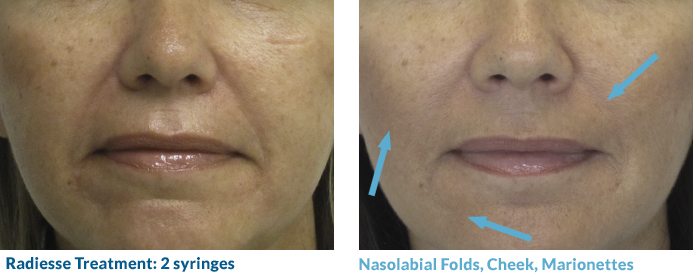 This patient responded well to 2 syringes of Radiesse in her nasolabial folds, cheek and marionettes. Using a cannula technique, we were able to treat her without any bruising!