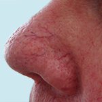 Immediately Before Treatment