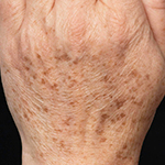 Before Fraxel Treatment for Hand Rejuvenation