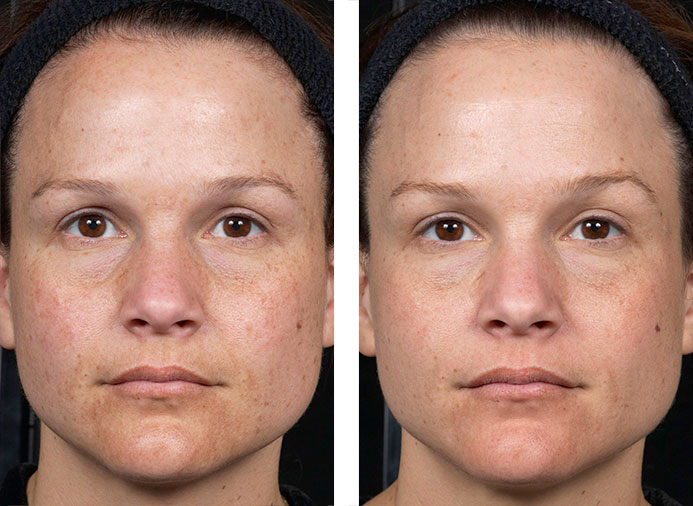 Clear + Brilliant: 1 Month following 6 Treatments