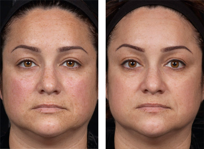 Clear + Brilliant: 1 Month following 6 Treatments