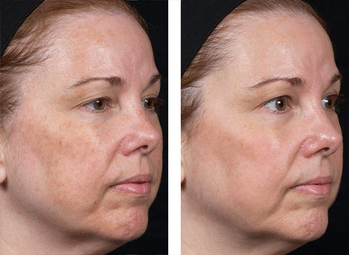 Clear + Brilliant: 1 Month following 6 Treatments