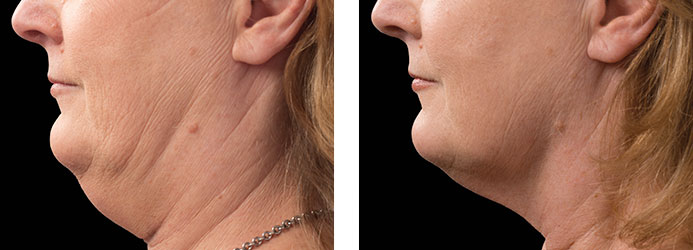 CoolSculpting: 12 weeks following 2 treatments on double chin (submental fat)