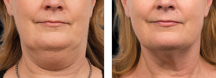 CoolSculpting: 12 weeks following 2 treatments on double chin (submental fat)