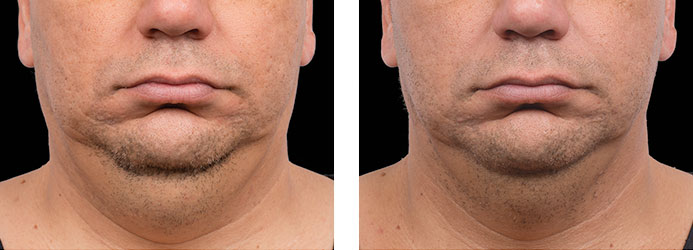 CoolSculpting: 12 weeks following 2 treatments on double chin (submental fat)