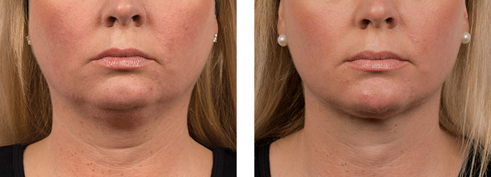 CoolSculpting: 12 weeks following 2 treatments on double chin (submental fat)