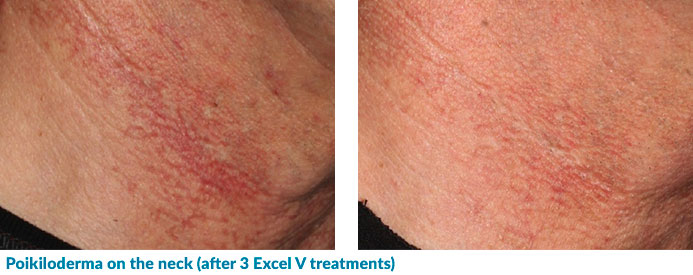 Excel V for Poikiloderma on the neck