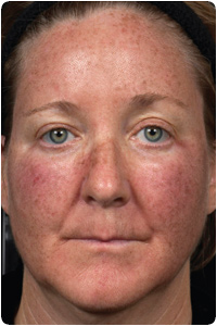 1 Day after Treatment