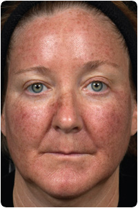 2 Days after Treatment