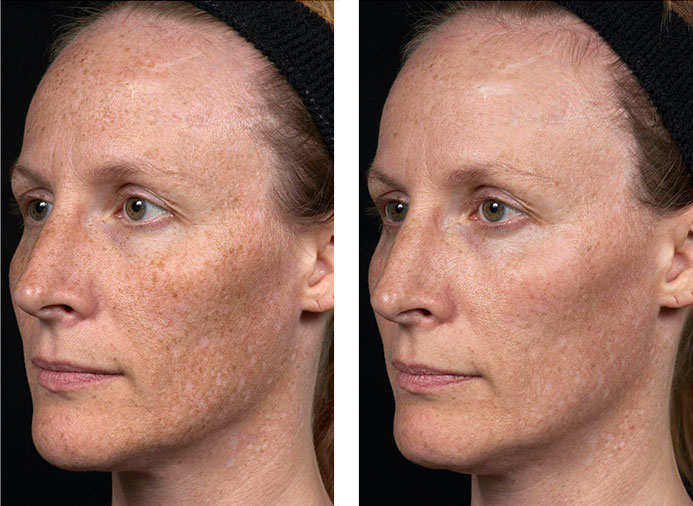 Fraxel 1927: 1 Month following 1 Treatment for Freckles and Uneven Pigment