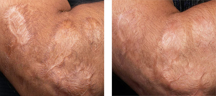 Treated with Fraxel 1550: 5 months following 4 treatments for scarring