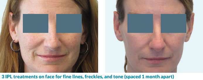 IPL for fine lines, freckles, tone